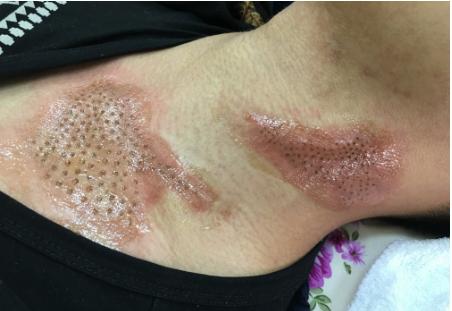 做激光大概多少钱,激光费用大概是多少