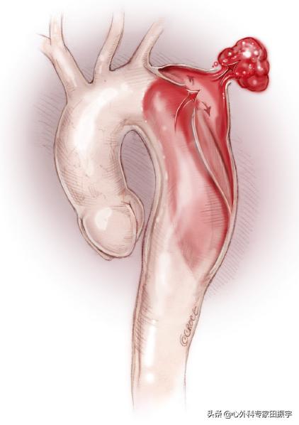 急性B型主动脉夹层合并主动脉破裂的急诊处理