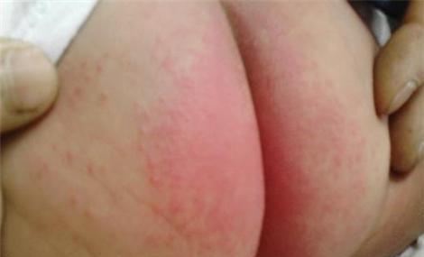 炉甘石治疗手痒正确用法,炉甘石洗剂老年人瘙痒