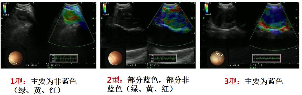 孙加源门诊,治疗肺癌的新技术新手段