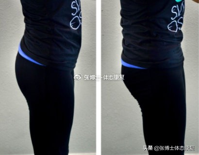 【体态矫正】骨盆后倾的形成原因与矫正训练