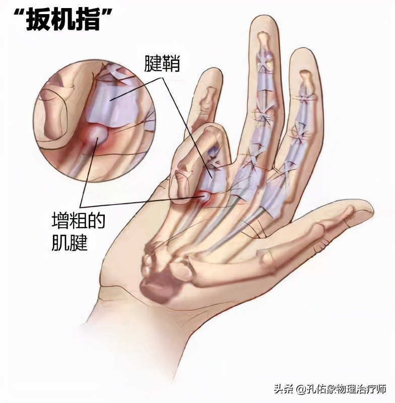 中年妇女手指疼痛僵硬是什么原因,老人手指腱鞘炎如何治疗
