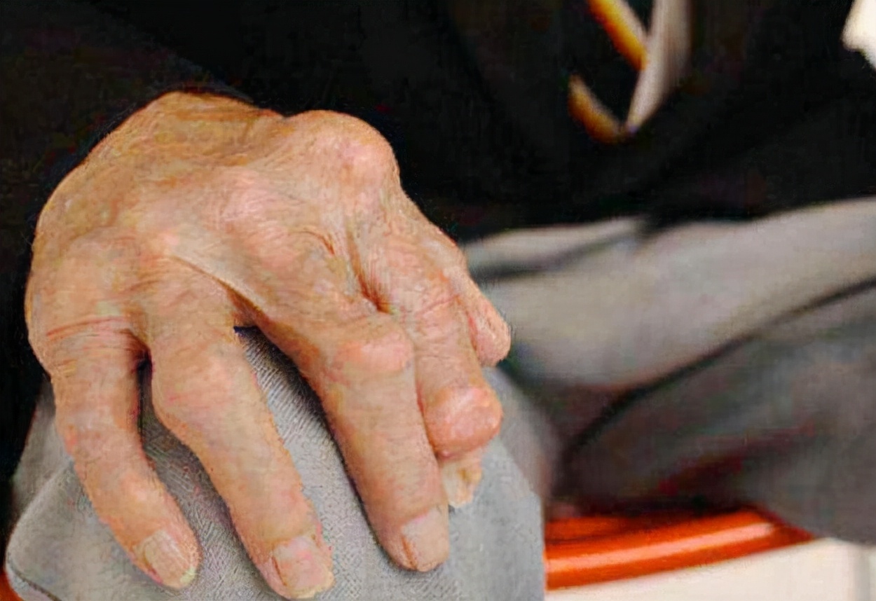 痛风为什么会发作导致关节疼,痛风急性发作怎么缓解关节疼痛