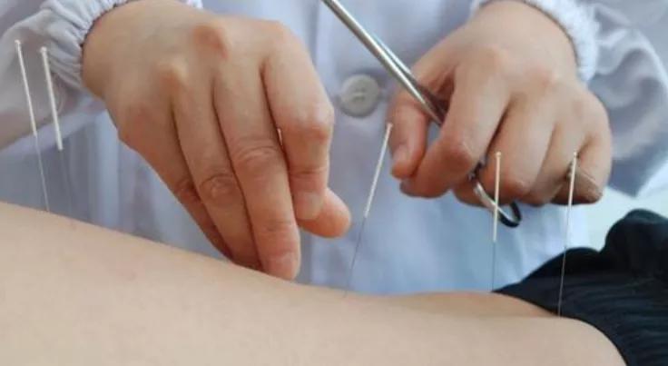 针灸可治疗促排卵吗,中医针灸可以促进排卵吗