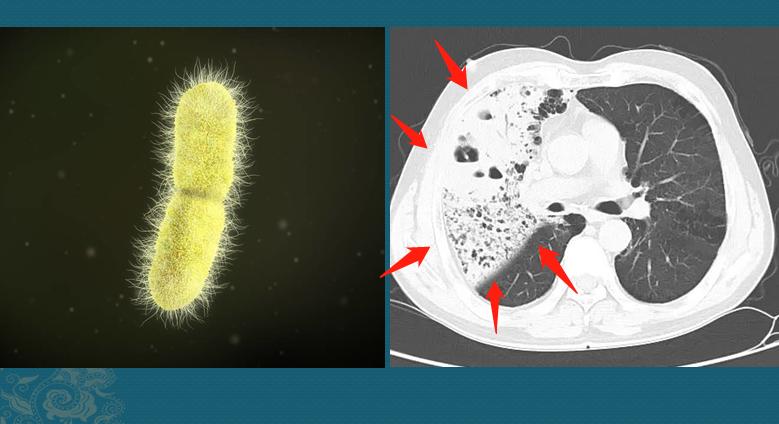 克雷伯氏肺炎菌,糖尿病人容易感染克雷伯菌吗