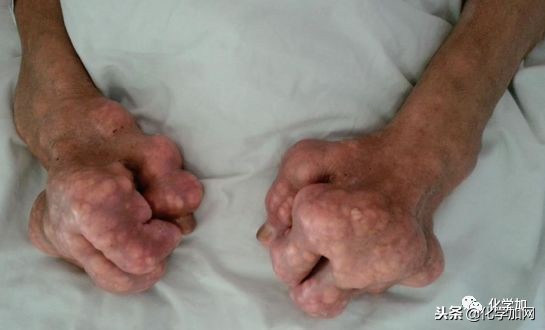 喝酒后手指关节疼怎么回事,喝酒对腿关节疼有影响吗