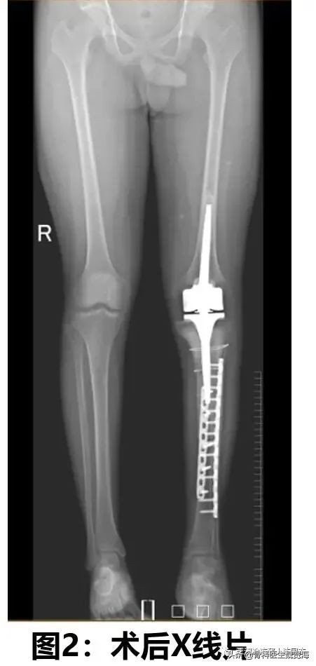 骨肿瘤保肢,骨肉瘤保肢手术