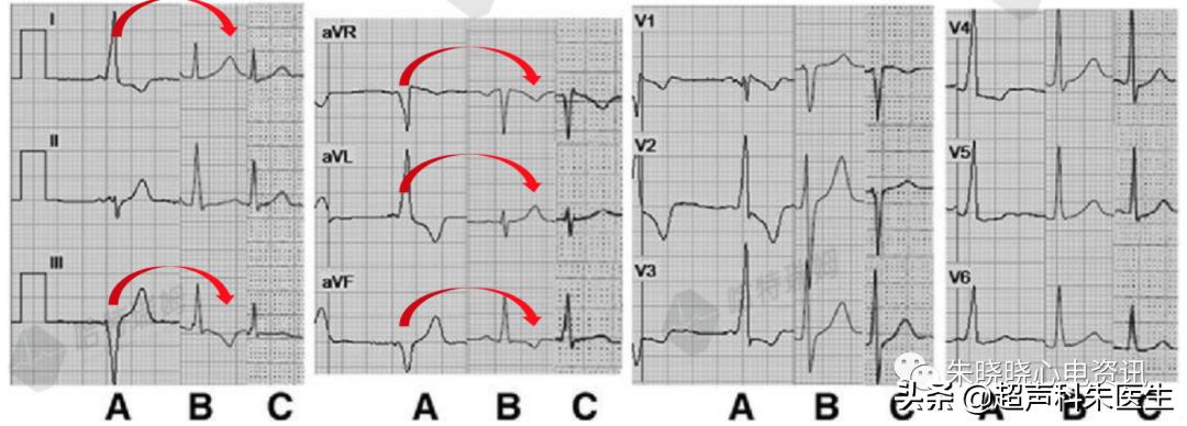 t波倒置9个真相图解,t波倒置判断口诀