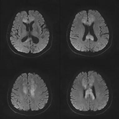 胼胝体有什么症状,胼胝体形态较小可以治疗吗