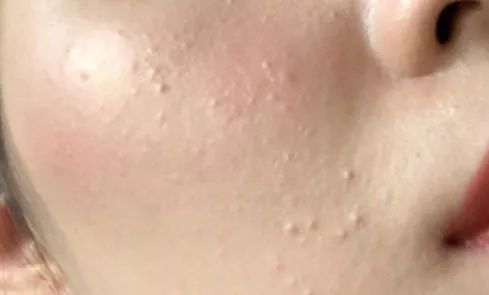 脸上的黑头粉刺挤不出来怎么办,脸部黑头粉刺有必要去美容院挤吗