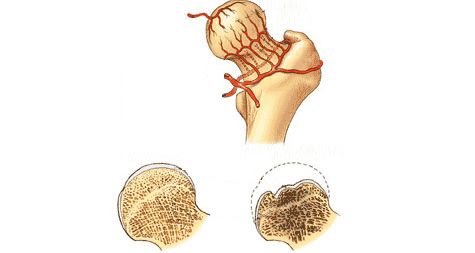 张建福大夫治疗股骨头,股骨头坏死张建福主任