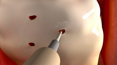 多囊卵巢综合征怎样促排卵,多囊卵巢综合症促排卵流程