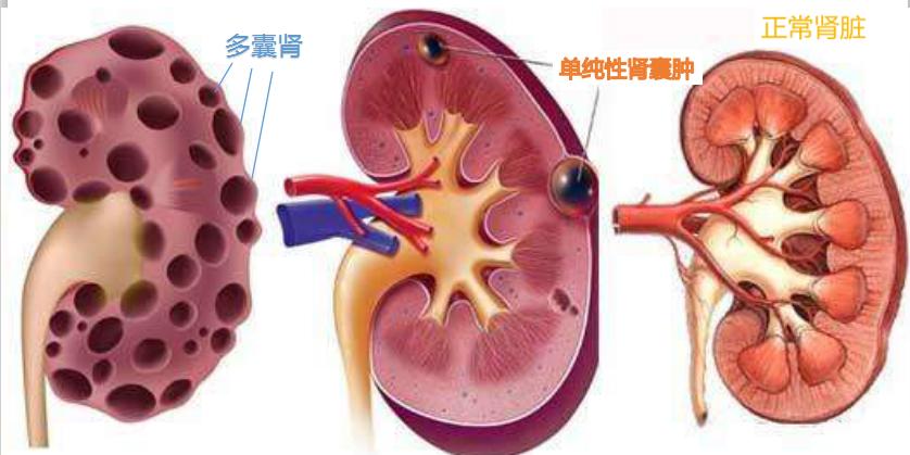 肾囊肿长到多大才需要手术?其实,大小不是唯一,还要看症状