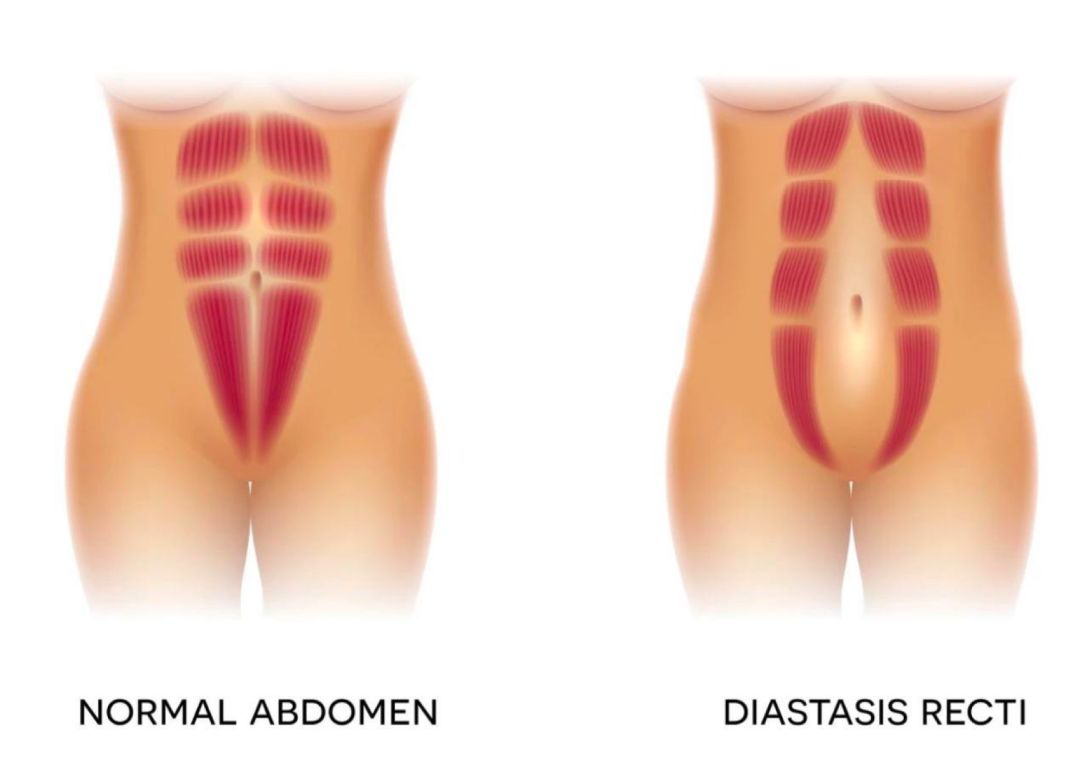 妇女产后骨盆修复按摩手法,按摩能修复骨盆和耻骨吗