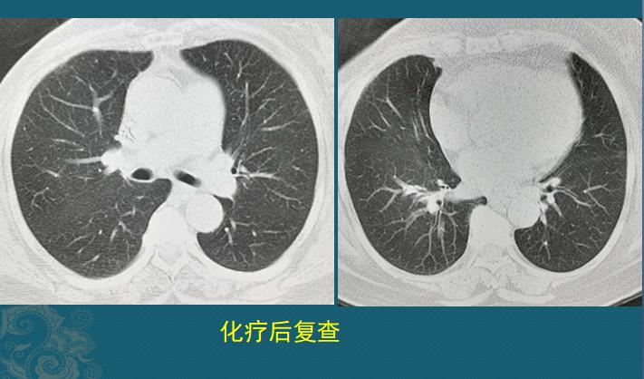 癌症转移到肺部就是肺癌了么,癌症患者转移到肝上多久才有症状