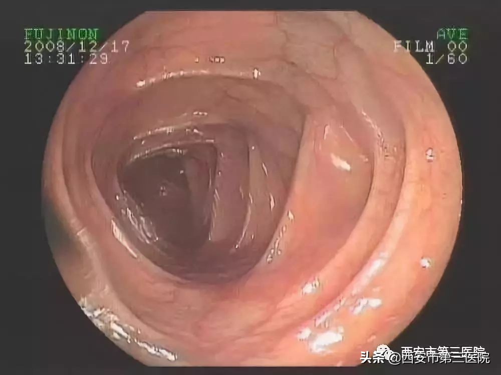 专家医生讲胆囊息肉,息肉是否越切长得越快