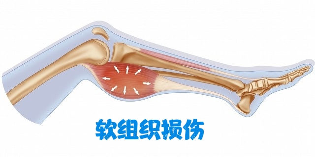 骨折愈合了为什么还会痛,骨折好了为什么还肿还疼