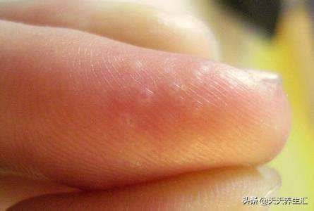 手上长水泡挠破了怎么办,手上起小水泡挠完了有点疼