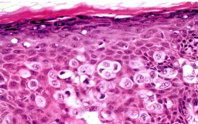 儿童过敏性紫癜是免疫系统疾病吗,过敏性紫癜属于自身免疫性疾病吗