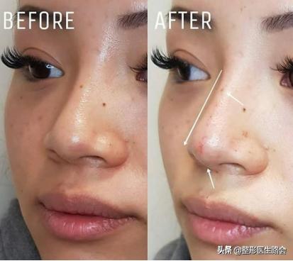 鼻整形手术风险,鼻整形副作用