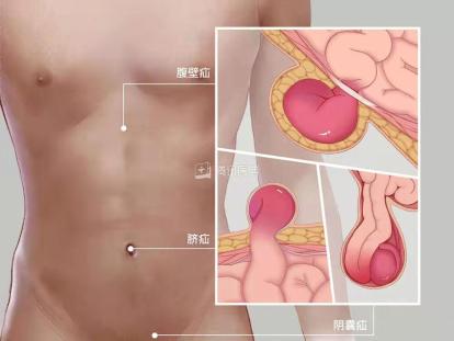 婴儿疝气开刀手术,疝气开刀要多少钱