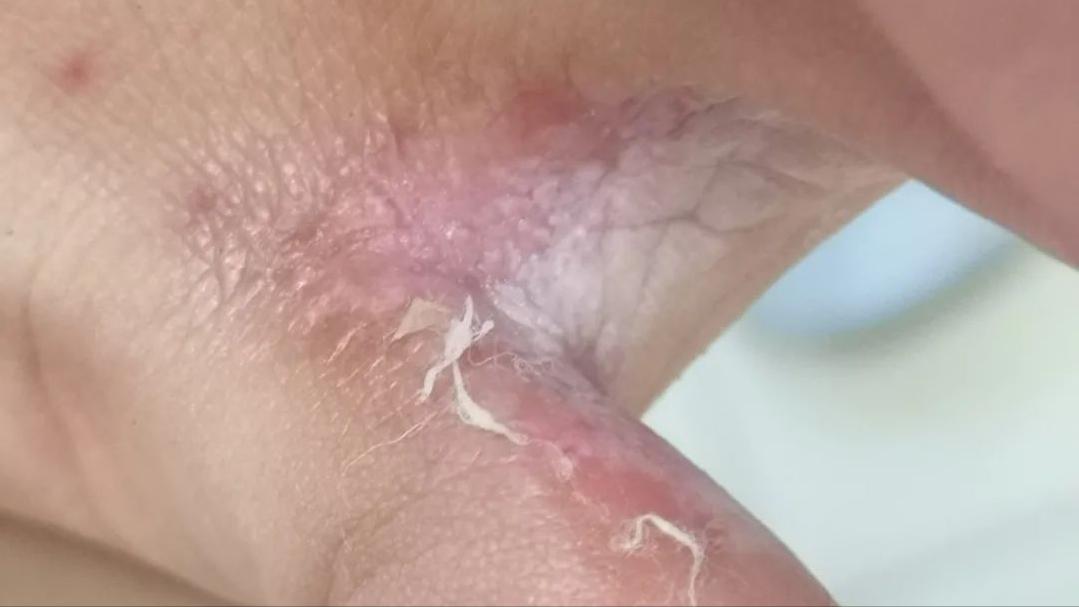 脚上真菌感染脱皮干裂怎么办,脚上脱皮又痒是真菌感染