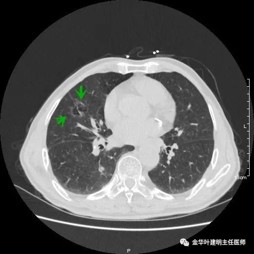 多发原发肺癌能根治吗,肺部原发性恶性肿瘤好治