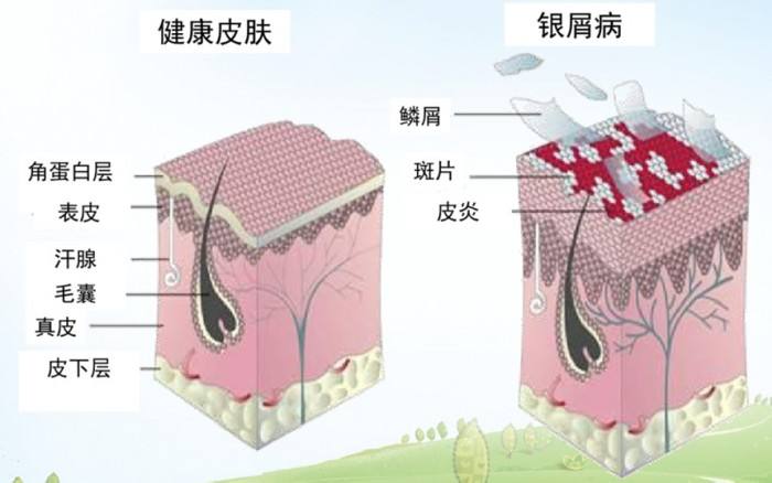 青岛肤研堂：中西医治疗银屑病/牛皮癣有何不同优势