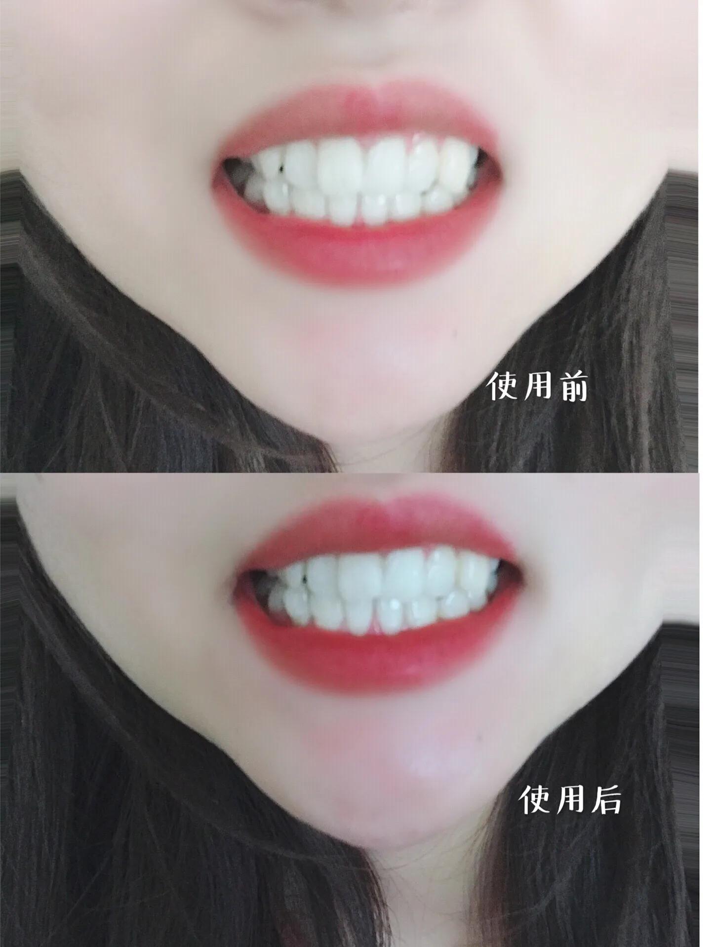 牙齿清洁到底有多重要,牙齿清洁到医院多少钱一次