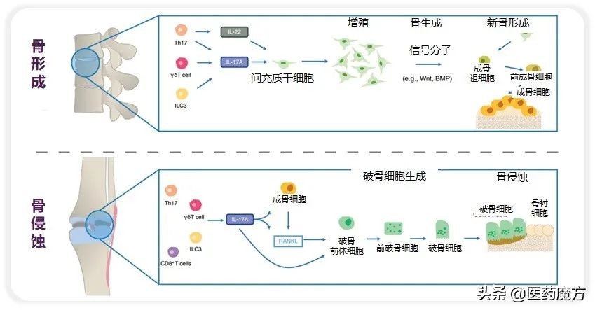 强直性脊柱炎治疗手段重大革新！诺华IL-17A单抗新适应症在华获批