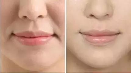 明星注射玻尿酸案例,注射玻尿酸变美