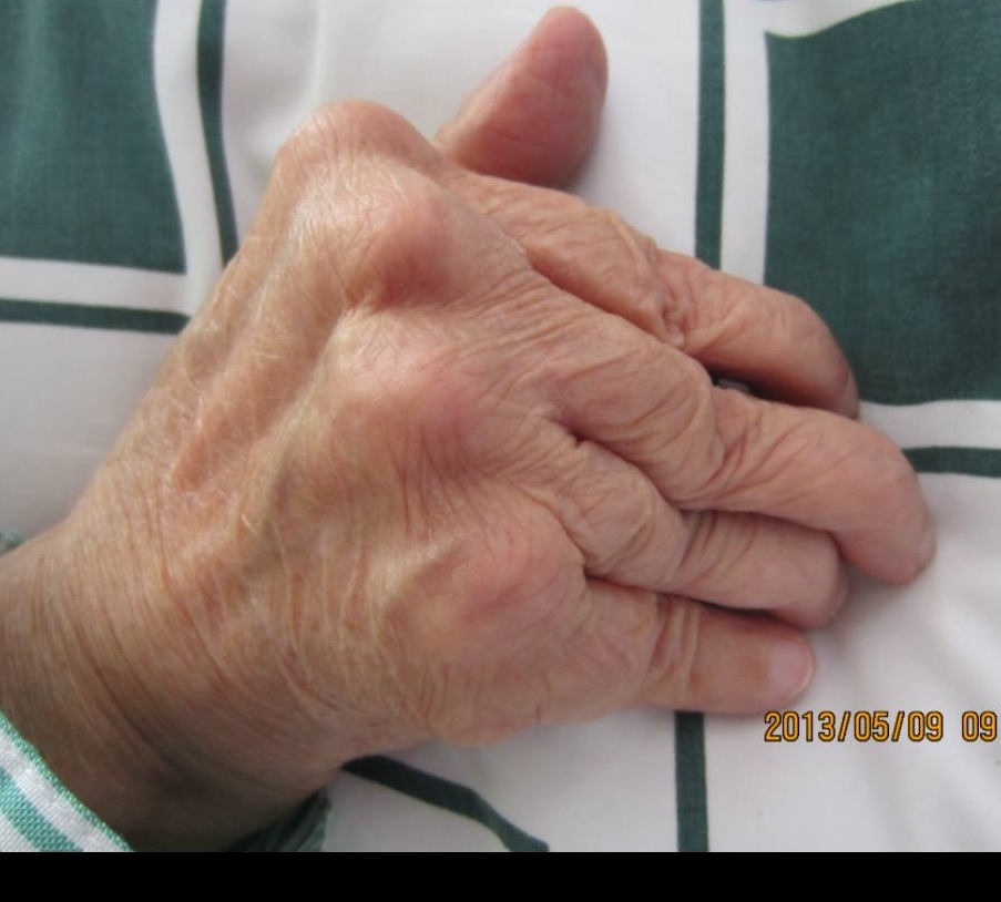 中医如何治疗类风湿关节炎,中医如何治疗类风湿滑膜炎