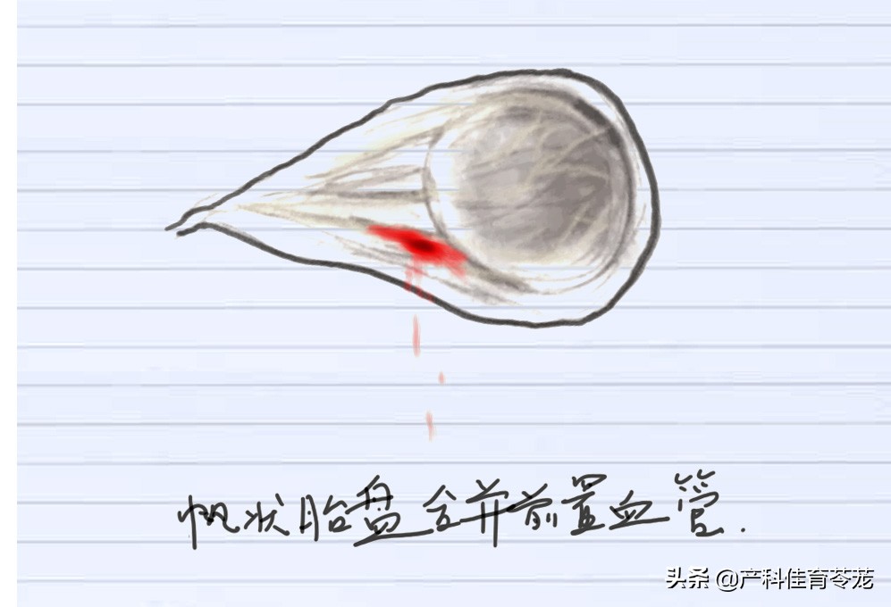 产科出血常见原因,产科医生生产前出血