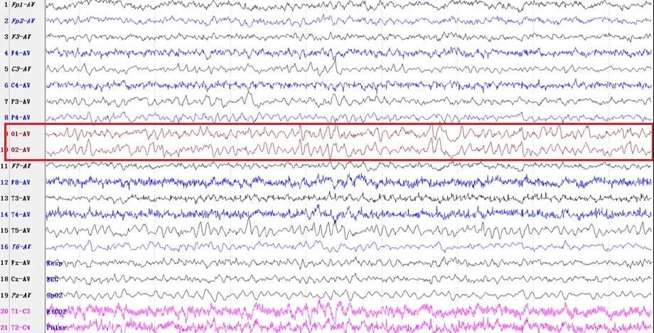 对诊断癫痫最有帮助的检查是,癫痫排查高频脑电波