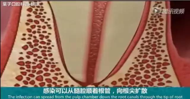 牙龈反复鼓包流脓是牙齿坏了吗,一上火牙龈就鼓包