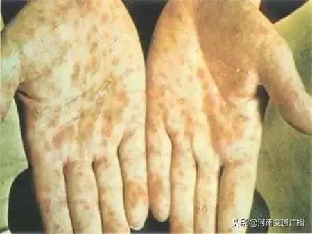 男子患梅毒20年没治疗,男子体检查出梅毒原因让人震惊了