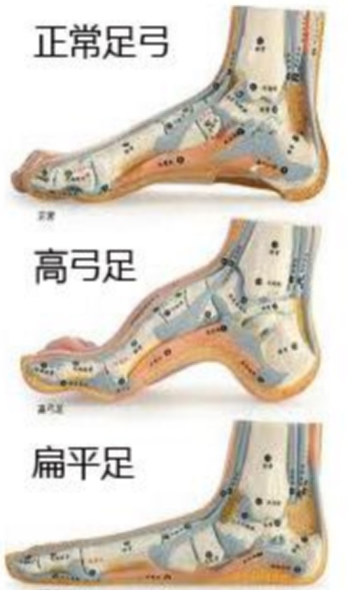 高弓足的保守锻炼治疗方法是什么,高弓足的表现和危害