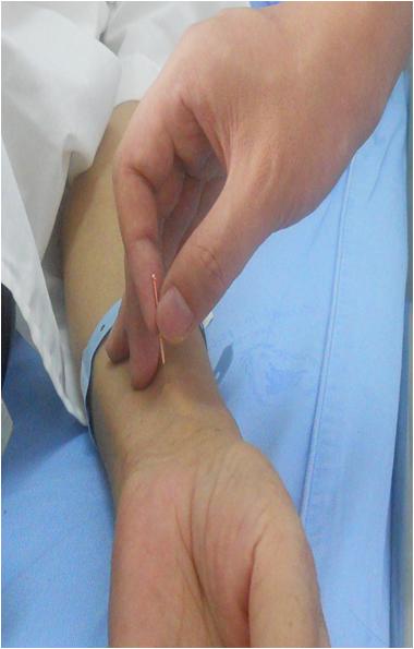 化疗后恶心呕吐怎么可以缓解,化疗后怎么避免恶心呕吐