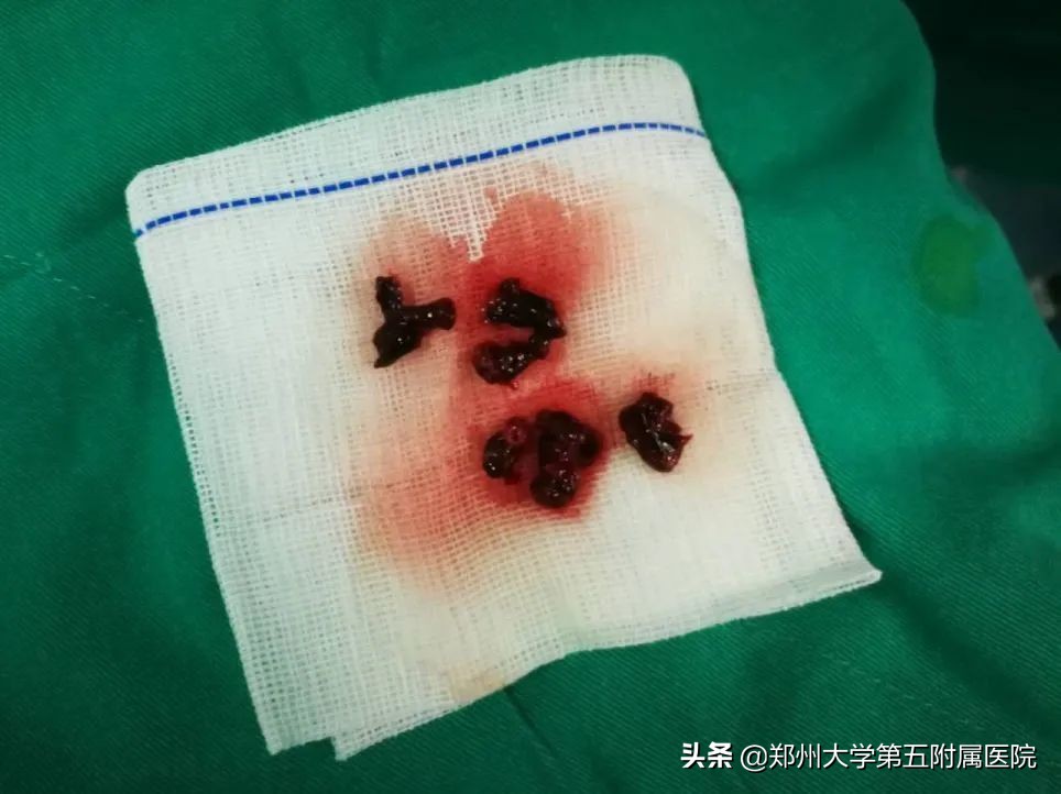 房颤患者的噩梦之不一样的急性腹痛——肠系膜上动脉栓塞