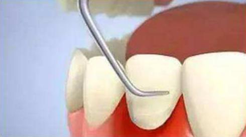 严重的牙周炎可以治好吗,严重牙周炎需要治疗吗