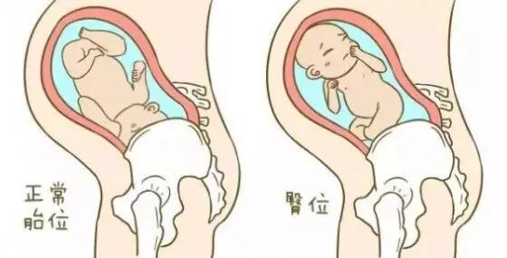 顺产和剖宫产的利弊,顺产和剖宫产的利弊有哪些