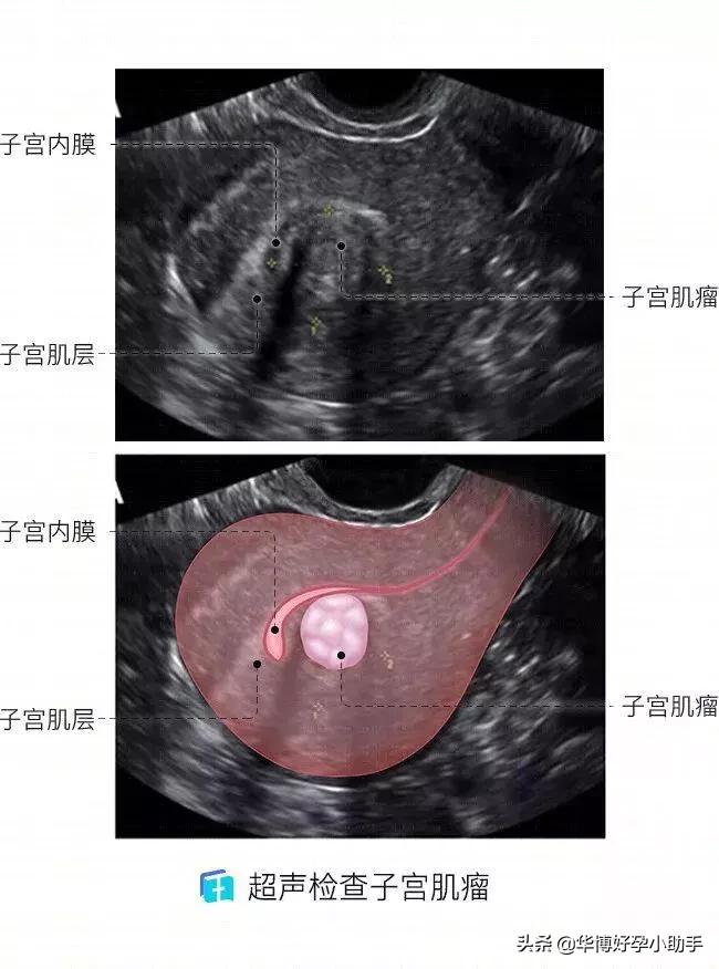 子宫肌瘤是咋把胎儿挤丢的？流产和不孕都是谁的错？备孕必读