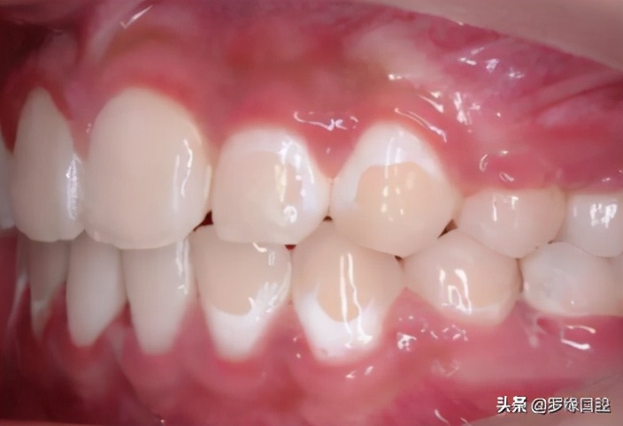 牙齿矫正后变黄怎么处理,矫正牙齿后牙齿为什么变黄了
