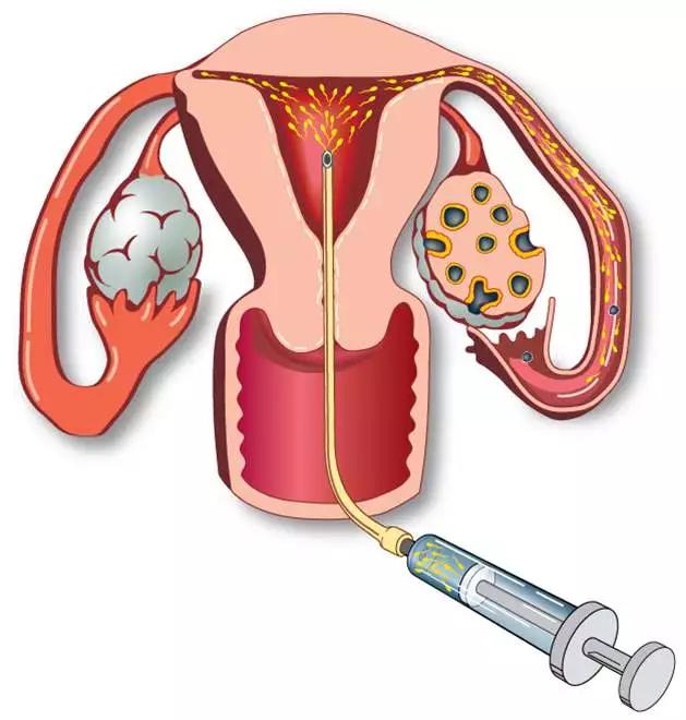 人工授精后多久才会有怀孕的现象,人工授精后影响下次怀孕吗