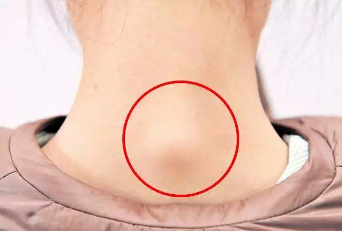 富贵包往往不是真的富贵包,富贵包的形成原因和危害