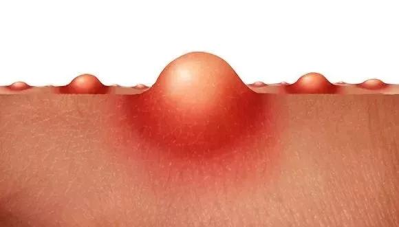 库博士祛痘痘效果怎么样,库博士专业祛痘长沙