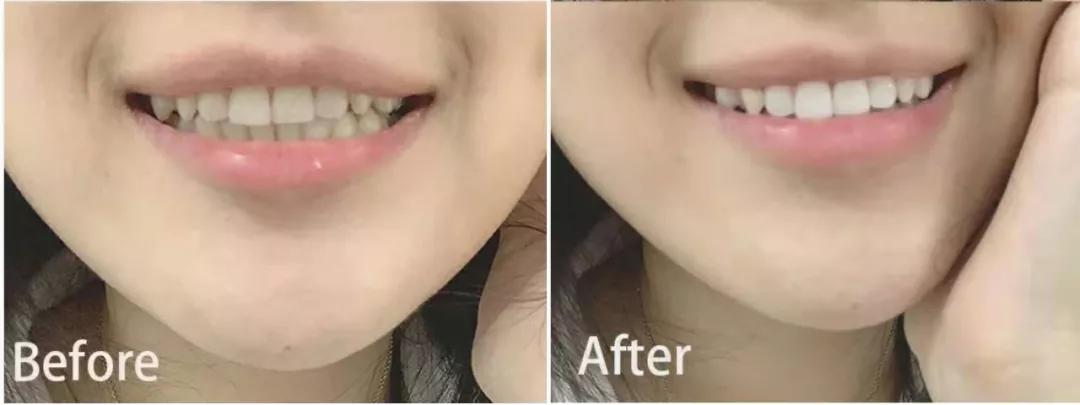 牙黄最有效变白方法,女性牙黄最有效的方法