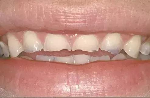 为什么牙齿内部会掉出来一小块,牙齿脱落跟缺钙有关吗