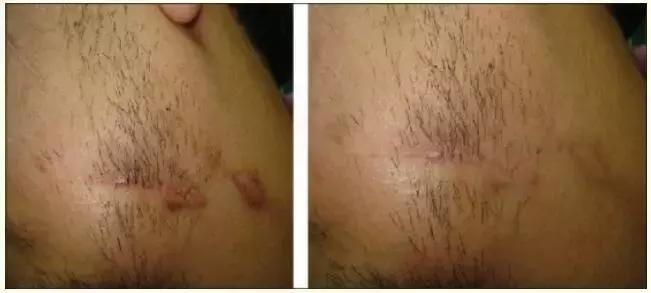 抗疤痕药什么价格,进口祛疤痕药