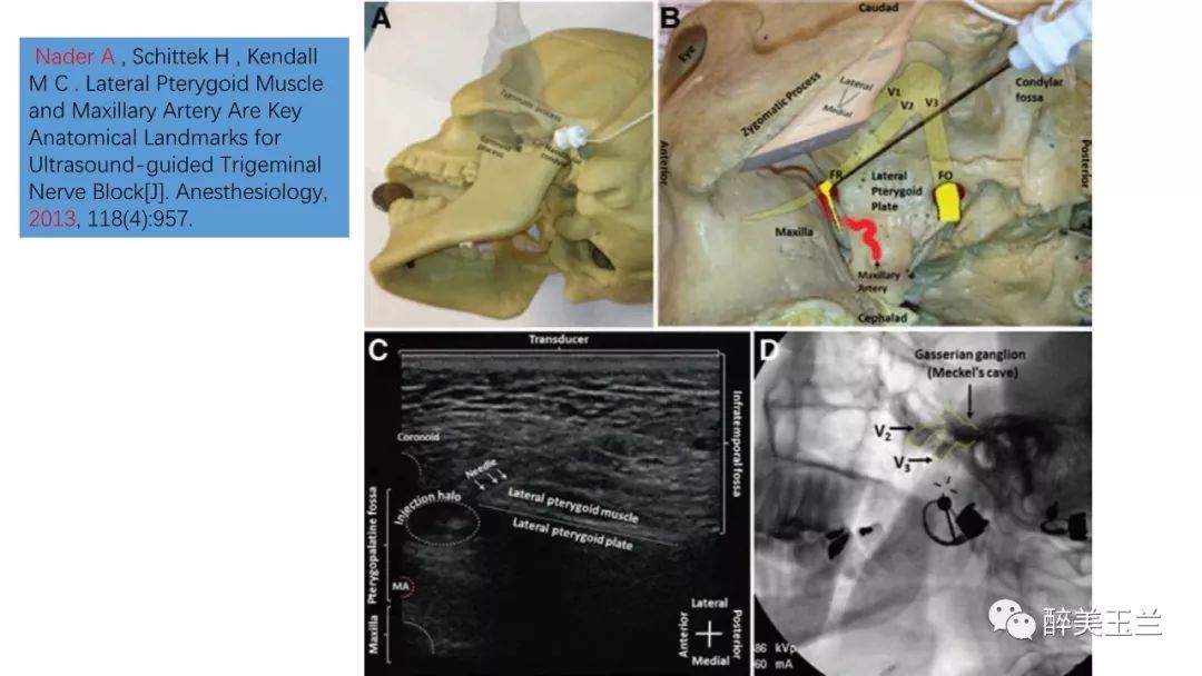 病例分享丨三叉神经节微球囊压迫术的麻醉管理